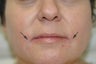 Restylane and Botox for mouth rejuvenation