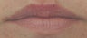 Lip enhancement with Restylane