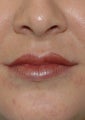 Restylane lip injections