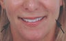 Restylane for cheek augmentation