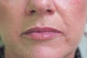 Restylane lip injections