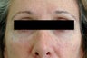 Restylane for dark circles under the eyes