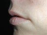 Restylane for upper lip
