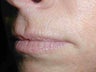 Restylane in Upper Lip