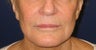 Restylane injection into lips and nasolabial folds