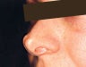 Injectables