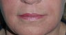 Lip Augmentation with Restylane