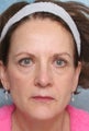 Undereye Deepfill Restylane® and Perioral Perlane®