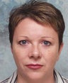 Microdroplet BOTOX® and Deepfill Restylane®