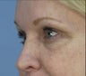 Restylane under Eyes