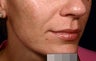 Restylane