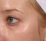 Restylane under eyes