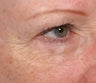 Resytlane under eyes