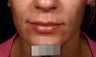 Restylane