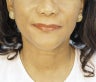 Lip Augmentation with filler