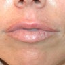 Uneven Lips Before and After Restylane