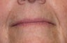 Restylane injection to nasolabial folds
