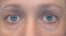 Restylane to tear trough deformity of lower lids
