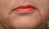 Restylane and Radiesse