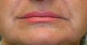 Restylane around the mouth