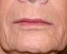 Restylane filler to the lips