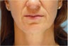 Restylane in Nasolabial folds and Marionette lines