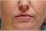 Lip augmentation
