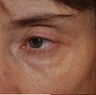 Restylane Injection into the Tear Troughs