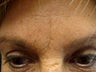 Immediate Improvement of a Forehead Wrinkle