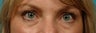 Restylane Filler for cheeks and eyes