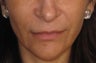 Restylane