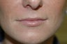 Lip augmentation