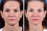 Fillers and Botox Cosmetic
