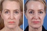 Restylane and Botox Cosmetic