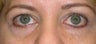 Restylane for eyes