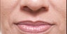 Restylane®