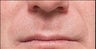 Restylane®
