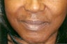 Restylane injection