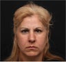 Restylane & Juvederm