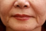 Fill the nasolabial folds and marionette lines