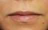 Lip Injection