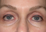 Tear trough filler
