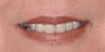 Smokers lines treated with Restylane and Botox in lips
