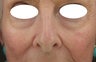 Midface, Cheeks, Tear troughs, and Nasolabial folds treated Restylane and Radiesse