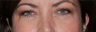 Restylane