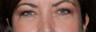 Restylane