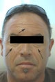 Restylane for dark circles under the eyes