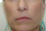Restylane Treatment for lips