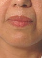 Restylane injections for laugh lines