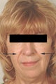 Restylane injections for laugh lines